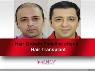 Hair Growth Timeline after a
Hair Transplant
 