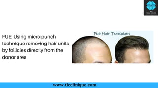Hair transplant treatment costs and all you would want to know