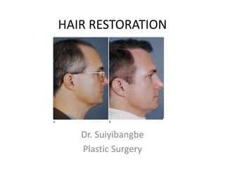 HAIR RESTORATION
Dr. Suiyibangbe
Plastic Surgery
 