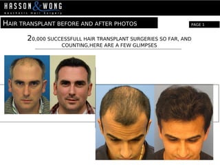 HAIR TRANSPLANT BEFORE AND AFTER PHOTOS
20,000 SUCCESSFULL HAIR TRANSPLANT SURGERIES SO FAR, AND
COUNTING,HERE ARE A FEW GLIMPSES
PAGE 1
 
