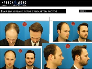 HAIR TRANSPLANT BEFORE AND AFTER PHOTOS PAGE 2
 