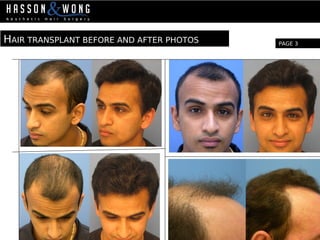 HAIR TRANSPLANT BEFORE AND AFTER PHOTOS PAGE 3
 