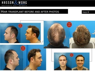 HAIR TRANSPLANT BEFORE AND AFTER PHOTOS PAGE 4
 