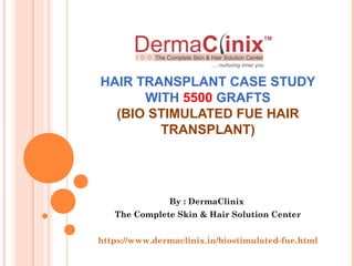 HAIR TRANSPLANT CASE STUDY
WITH 5500 GRAFTS
(BIO STIMULATED FUE HAIR
TRANSPLANT)
By : DermaClinix
The Complete Skin & Hair Solution Center
https://www.dermaclinix.in/biostimulated-fue.html
 