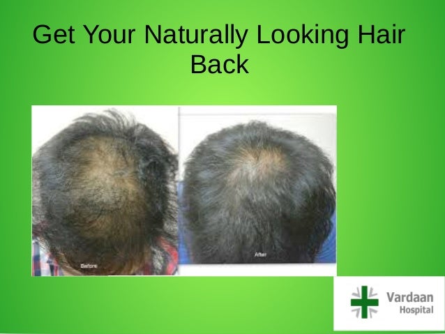 Hair Transplant Delhi Cost Of Hair Transplant In Delhi