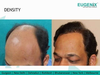 Celebrity Hair Transplant in India Celebrity Hair Transplant Clinic
