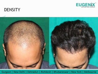 Hair transplant in Delhi at eugenix hair sciences