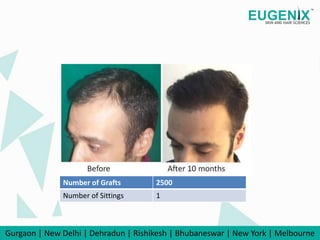 eugenix: Reversing cosmetic tourism: DHT technique by Eugenix Hair Sciences  is weaving a success story in hair restoration - The Economic Times