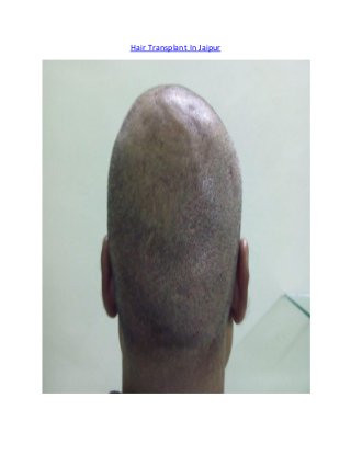 Hair Transplant In Jaipur
 