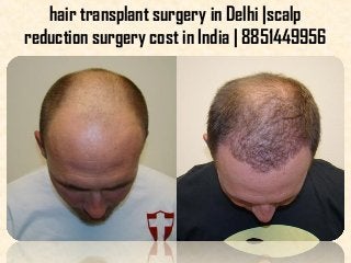 hair transplant surgery in Delhi |scalp
reduction surgery cost in India | 8851449956
 