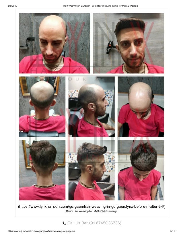 Hair Weaving In Gurgaon Best Hair Weaving Clinic For Men Amp Women