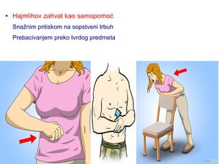 ● Hajmlihov zahvat kao samopomoć
Snažnim pritiskom na sopstveni trbuh
Prebacivanjem preko tvrdog predmeta
 
