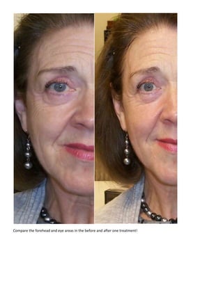 Compare the forehead and eye areas in the before and after one treatment!<br />