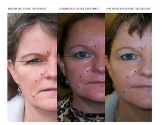 BEFORE GALVANIC TREATMENT   IMMEDIATELY AFTER TREATMENT   ONE HOUR AFTER FIRST TREATMENT
 