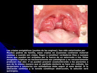 Las criptas amigdalinas (puntos de las anginas), han sido satanizadas por
Muchos padres de familia, estas criptas en ocasiones contienen material
caseoso y cuando son viejas, llegan a constituir verdaderos litos o cuerpos
duros que pueden ser arojados por la fuerza de un estornudo o tos. Estas
amigdalas crípticas no necesariamente son patológicas y no necesariamente
producen mal olor. Y se pueden prevenir acostumbrando a los pacientes a
que de la misma manera que el cepillado dentario se hace con método, los
gargarismo o colutorios con antisépticos debe seguir al aseo dental. Si la
alteración continúa y la tonsila constituye obstrucción, la solución será
quirúrgica.
 