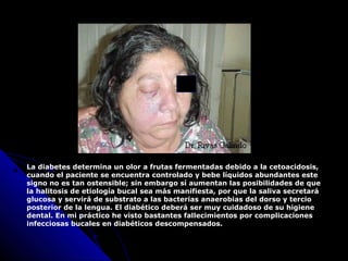 La diabetes determina un olor a frutas fermentadas debido a la cetoacidosis,
cuando el paciente se encuentra controlado y bebe líquidos abundantes este
signo no es tan ostensible; sin embargo sí aumentan las posibilidades de que
la halitosis de etiología bucal sea más manifiesta, por que la saliva secretará
glucosa y servirá de substrato a las bacterias anaerobias del dorso y tercio
posterior de la lengua. El diabético deberá ser muy cuidadoso de su higiene
dental. En mi práctico he visto bastantes fallecimientos por complicaciones
infecciosas bucales en diabéticos descompensados.
 