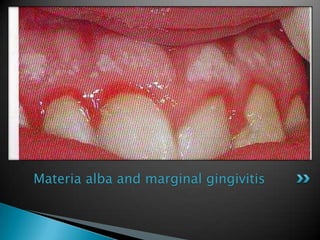 Materia alba and marginal gingivitis
 