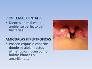 PROBLEMAS DENTALES
• Dientes en mal estado,
ambiente perfecto de
bacterias.

AMIGDALAS HIPERTROFICAS
• Poseen criptas o espacios
donde se alojan restos
alimenticios, lucen como
bolitas blancas o
amarillentas.

 