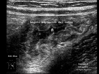 Angulo esplénico del colon Copyright © OCA Hospital All Rights Reserved 