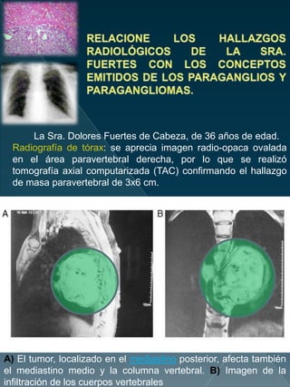 La Sra. Dolores Fuertes de Cabeza, de 36 años de edad.
Radiografía de tórax: se aprecia imagen radio-opaca ovalada
en el área paravertebral derecha, por lo que se realizó
tomografía axial computarizada (TAC) confirmando el hallazgo
de masa paravertebral de 3x6 cm.
A) El tumor, localizado en el mediastino posterior, afecta también
el mediastino medio y la columna vertebral. B) Imagen de la
inﬁltración de los cuerpos vertebrales
 