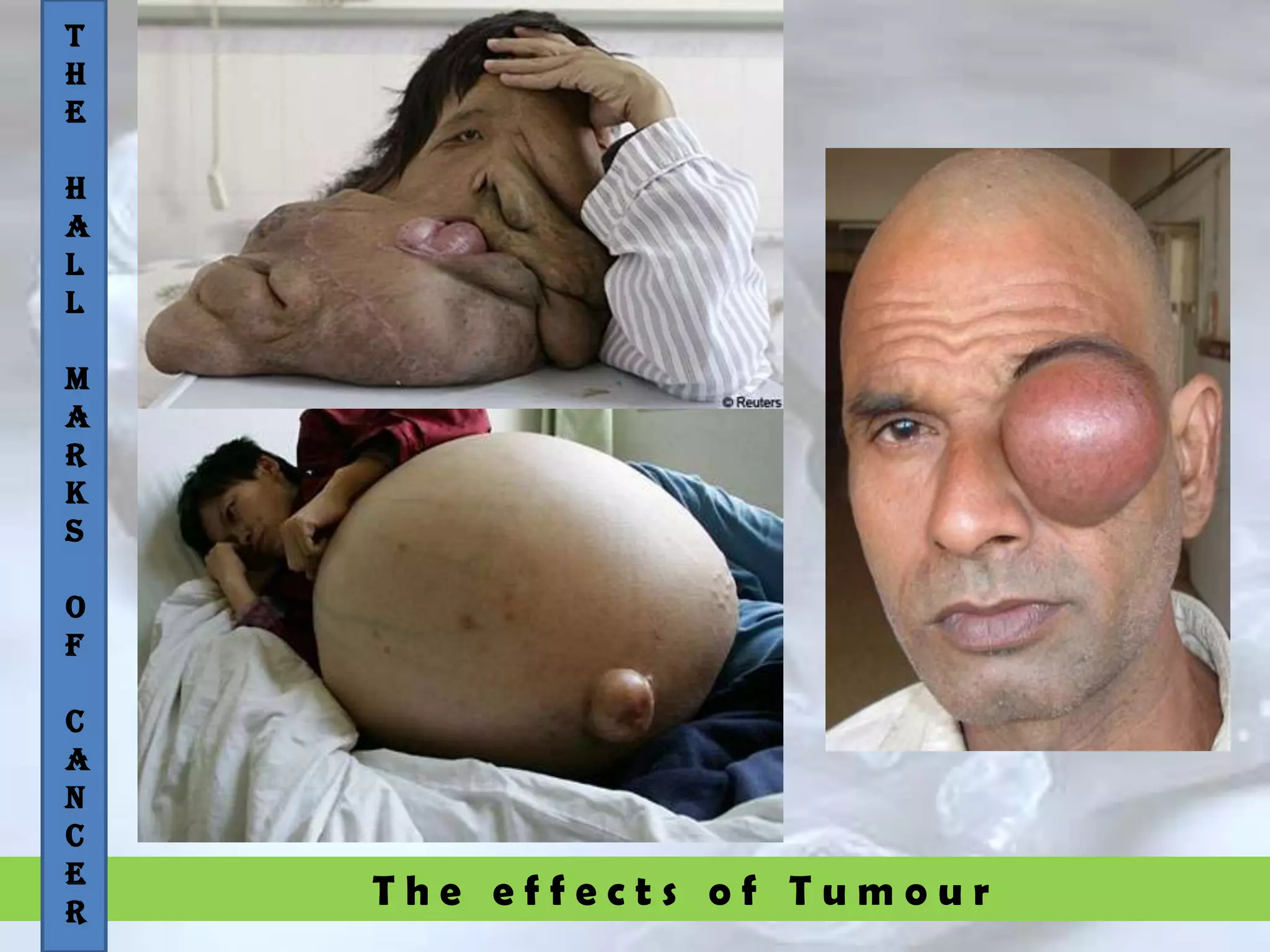 T h e e f f e c t s o f T u m o u r
T
H
E
H
A
L
L
M
A
R
K
S
O
F
C
A
N
C
E
R
 
