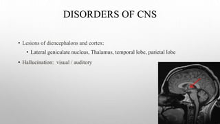DISORDERS OF CNS
• Lesions of diencephalons and cortex:
• Lateral geniculate nucleus, Thalamus, temporal lobe, parietal lobe
• Hallucination: visual / auditory
 