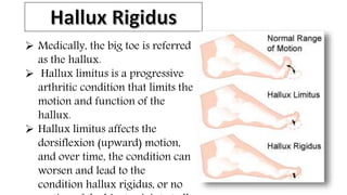  Medically, the big toe is referred
as the hallux.
 Hallux limitus is a progressive
arthritic condition that limits the
motion and function of the
hallux.
 Hallux limitus affects the
dorsiflexion (upward) motion,
and over time, the condition can
worsen and lead to the
condition hallux rigidus, or no
 