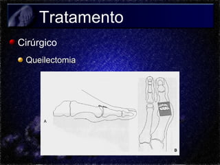 Tratamento
Cirúrgico
Queilectomia

 