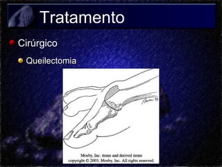 Tratamento
Cirúrgico
Queilectomia

 
