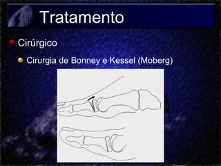 Tratamento
Cirúrgico
Cirurgia de Bonney e Kessel (Moberg)

 