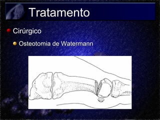 Tratamento
Cirúrgico
Osteotomia de Watermann

 