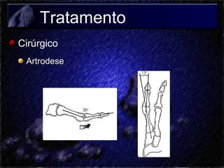 Tratamento
Cirúrgico
Artrodese

 