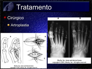 Tratamento
Cirúrgico
Artroplastia

 
