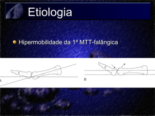 Etiologia
Hipermobilidade da 1ª MTT-falângica

 