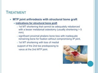 TREATMENT
 MTP joint arthrodesis with structural bone graft
 indications for structural bone graft
 1st MT shortening that cannot be adequately rebalanced
with a lesser metatarsal osteotomy (usually shortening > 5
mm)
 significant proximal phalanx bone loss with inadequate
remaining bone for fixation without compromising IP joint,
 1st MT shortening with loss of medial
support of the 2nd toe predisposing to
varus at the 2nd MTP joint.
 
