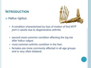 INTRODUCTION
 Hallux rigidus:
 A condition characterized by loss of motion of first MTP
joint in adults due to degenerative arthritis
 second most common condition affecting the big toe
after hallux valgus
 most common arthritic condition in the foot.
 females are more commonly affected in all age groups
and is very often bilateral.
 