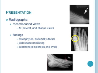 PRESENTATION
 Radiographs:
 recommended views
 AP, lateral, and oblique views
 findings
 osteophytes, especially dorsal
 joint space narrowing
 subchondral sclerosis and cysts
 