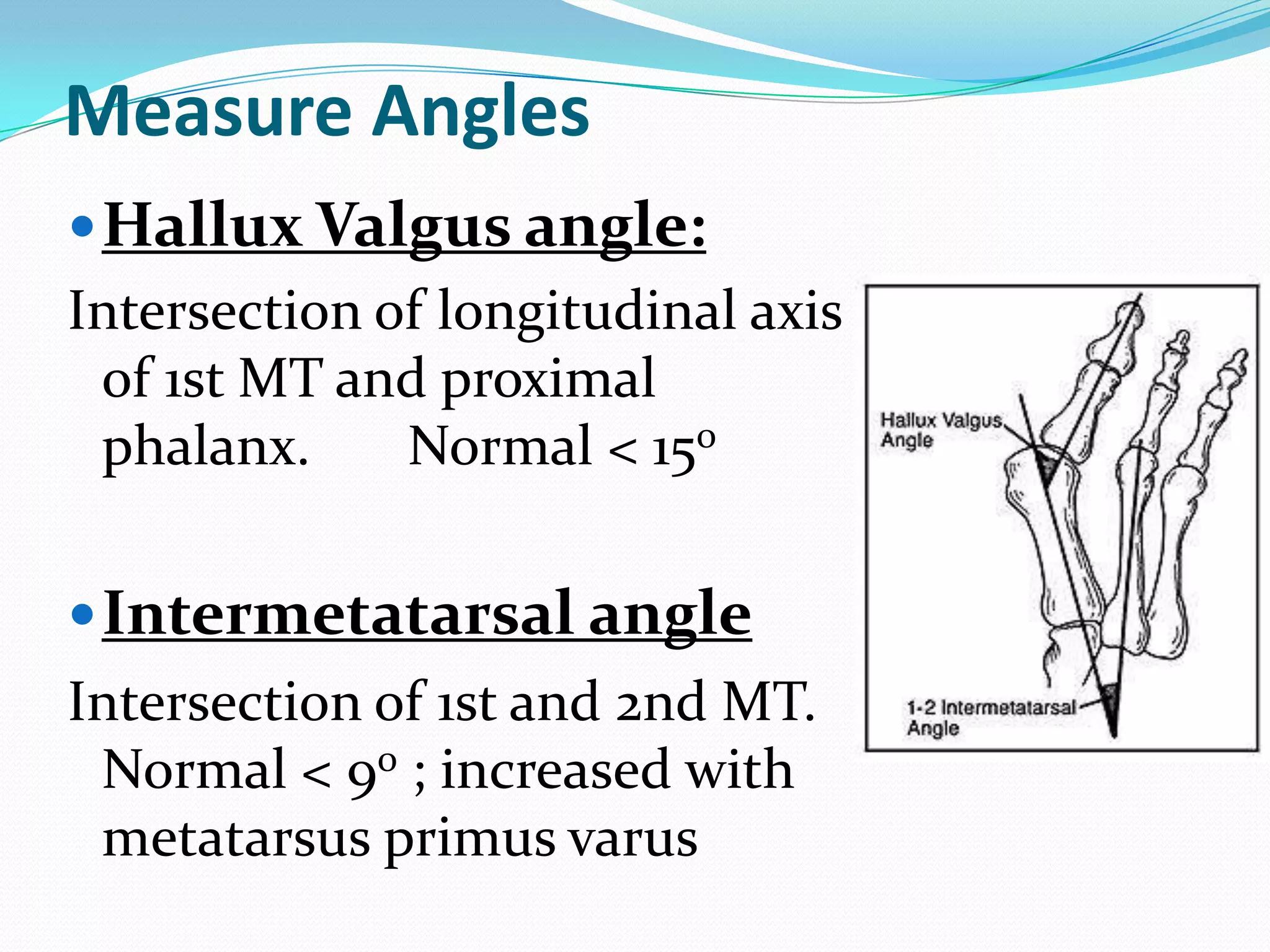 Measure Angles
 Hallux Valgus angle:
Intersection of longitudinal axis
 of 1st MT and proximal
 phalanx.     Normal < 150


 Intermetatarsal angle
Intersection of 1st and 2nd MT.
 Normal < 90 ; increased with
 metatarsus primus varus
 