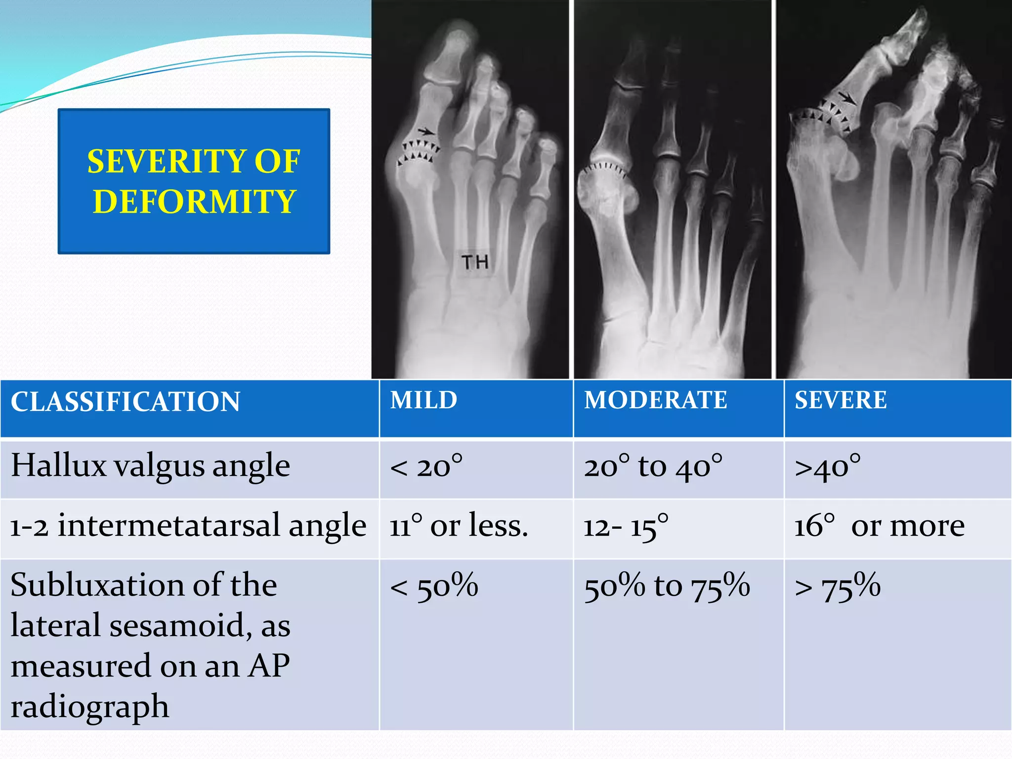 SEVERITY OF
     DEFORMITY




CLASSIFICATION             MILD          MODERATE     SEVERE

Hallux valgus angle        < 20°         20° to 40°   >40°
1-2 intermetatarsal angle 11° or less.   12- 15°      16° or more
Subluxation of the         < 50%         50% to 75%   > 75%
lateral sesamoid, as
measured on an AP
radiograph
 