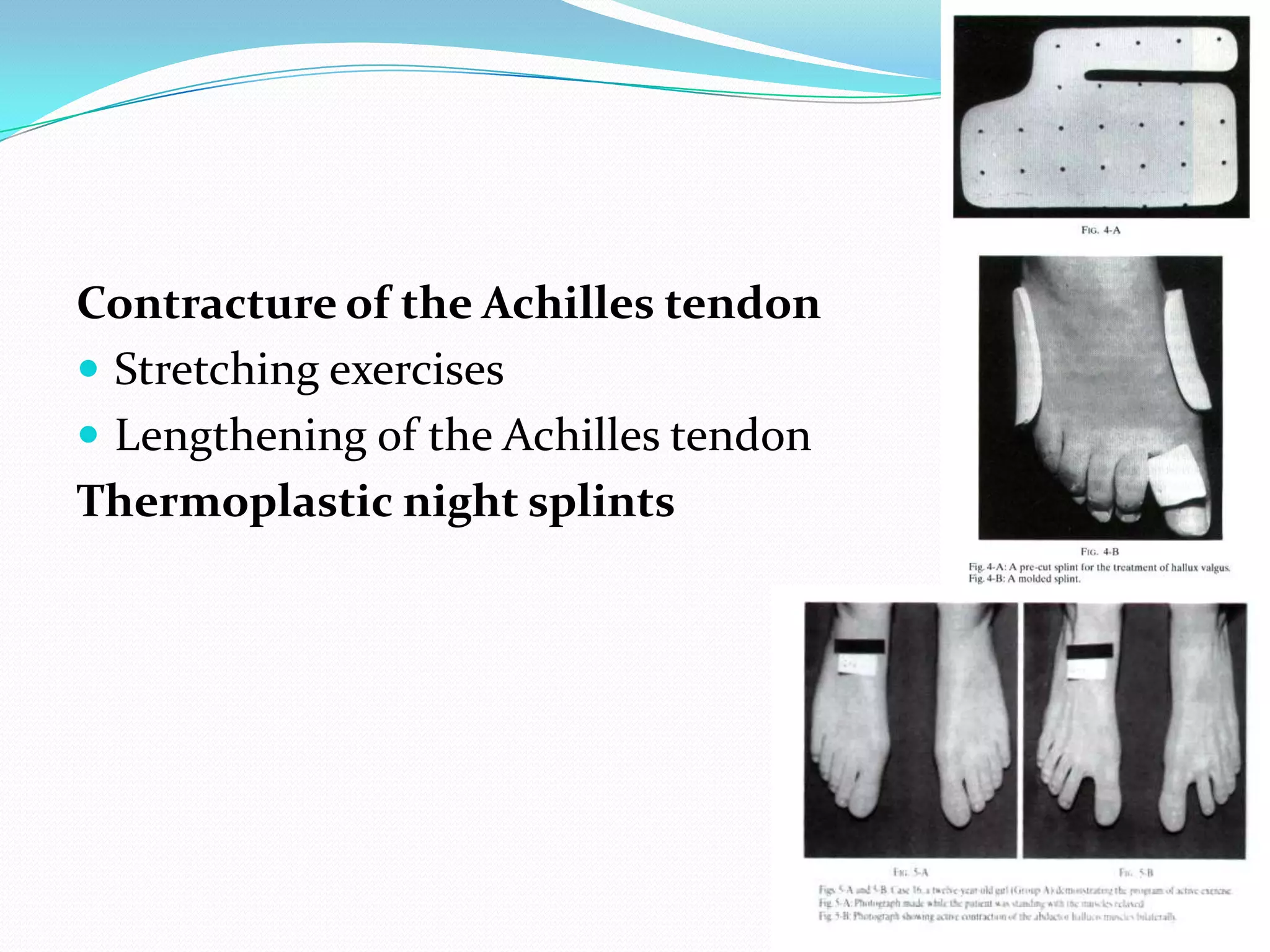 Contracture of the Achilles tendon
 Stretching exercises
 Lengthening of the Achilles tendon
Thermoplastic night splints
 