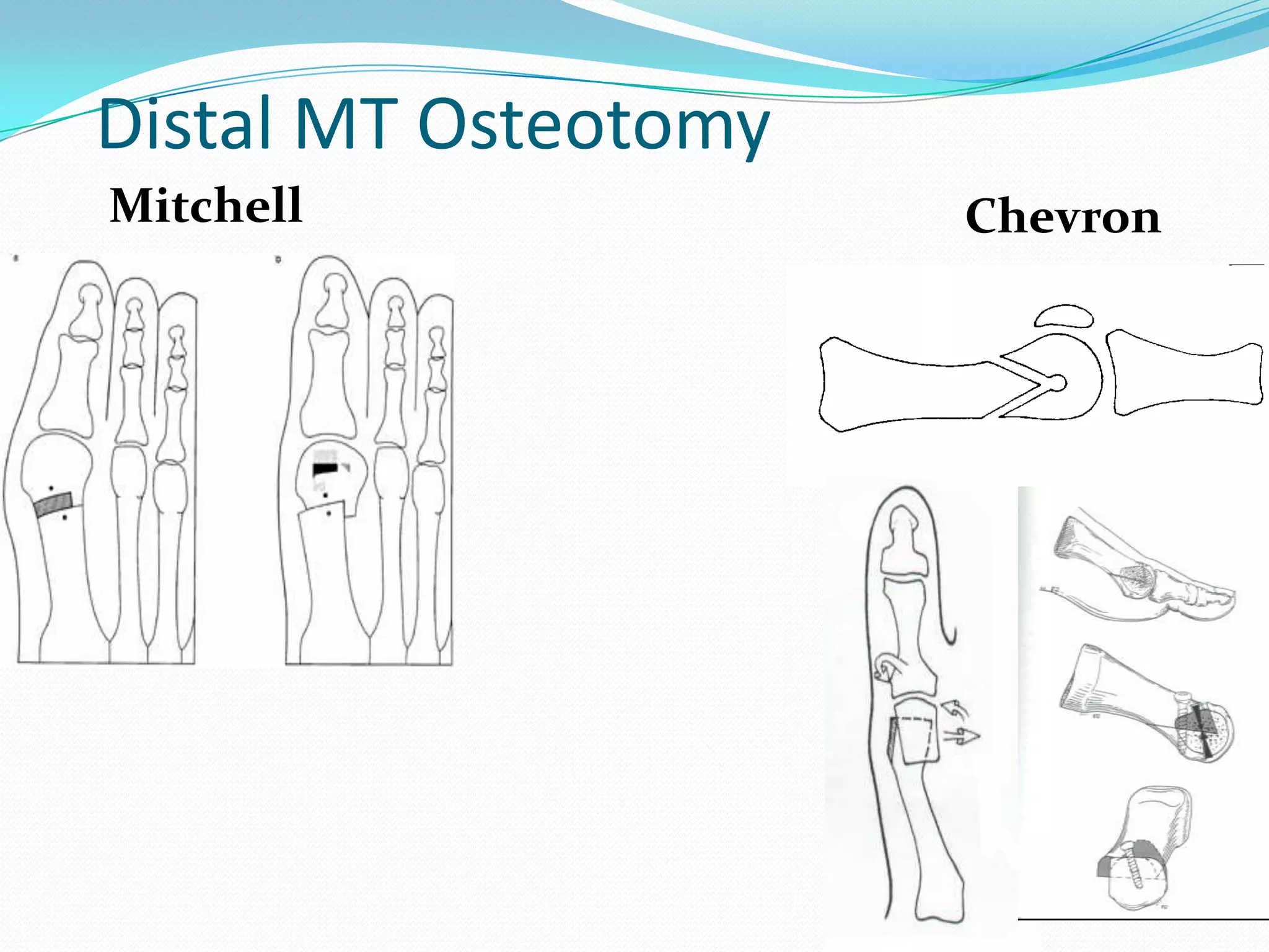 Distal MT Osteotomy
Mitchell              Chevron
 