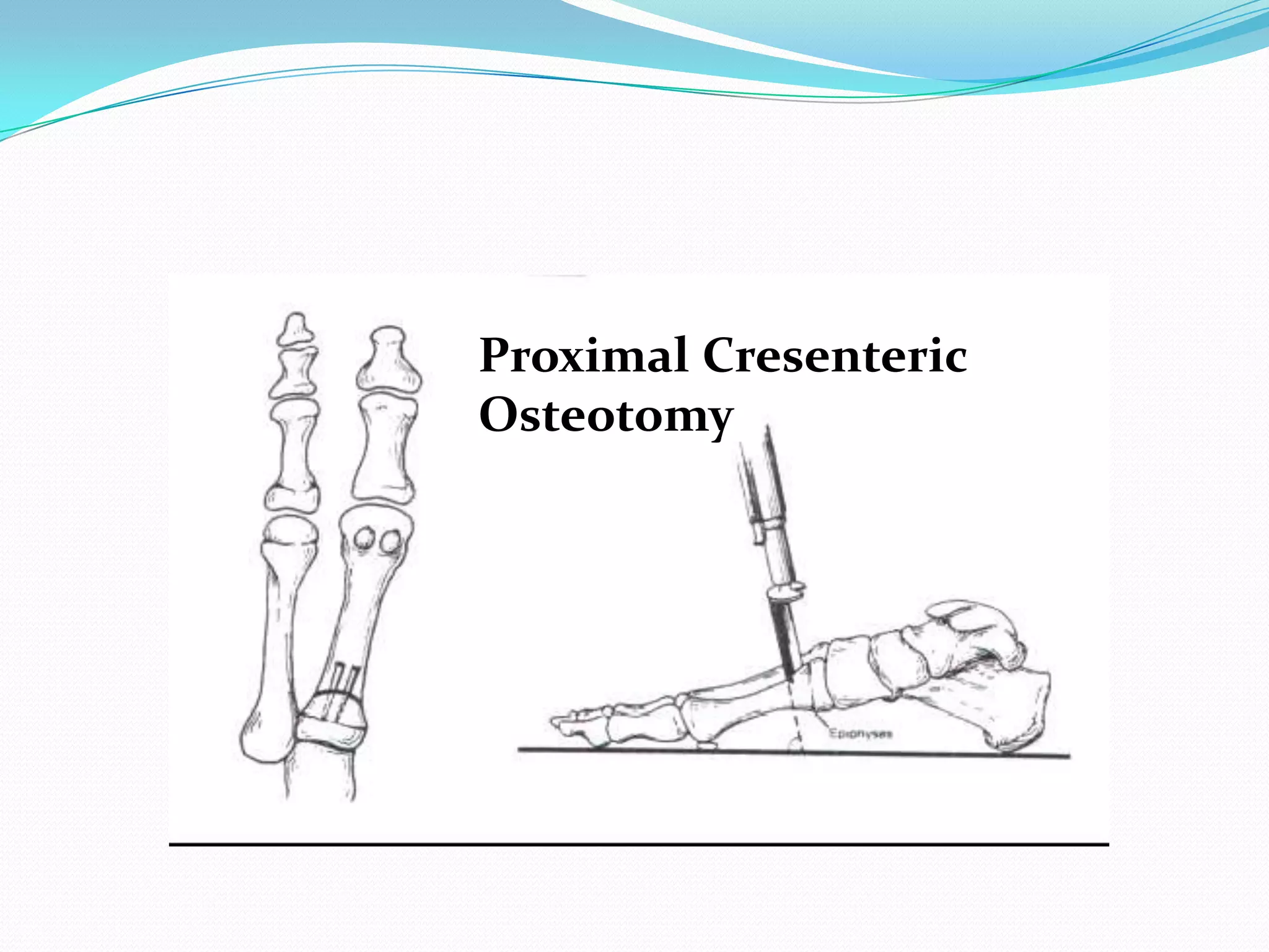 Proximal Cresenteric
Osteotomy
 