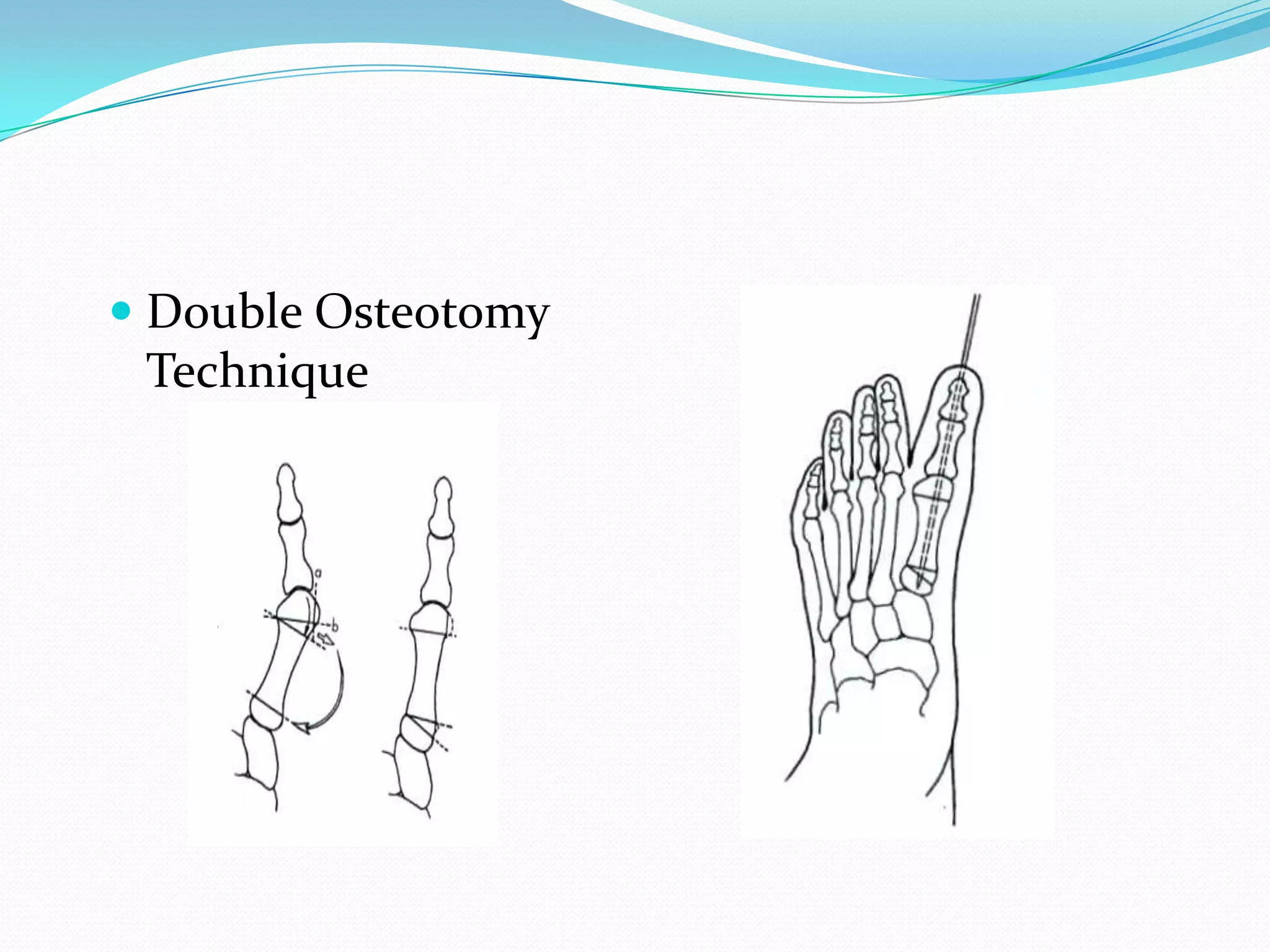  Double Osteotomy
  Technique
 