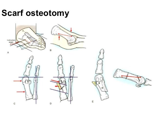 juvenile rheumatoid arthritis