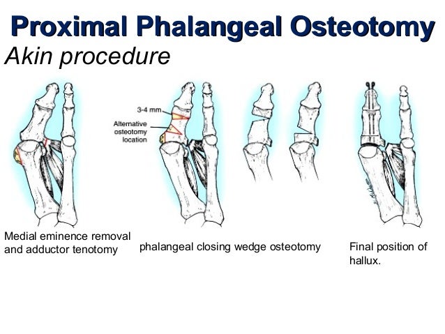 Hallux valgus