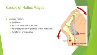 Causes of Hallux Valgus
 Intrinsic Factors:
 Pes Planus
 Articular surface of 1st MP joint
 Advanced position of great toe and its metatarsal.
 Metatarsus primus varus
 
