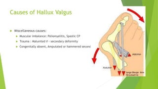 Causes of Hallux Valgus
 Miscellaneous causes:
 Muscular imbalance: Poliomyelitis, Spastic CP
 Trauma : Malunited # - secondary deformity
 Congenitally absent, Amputated or hammered second toe
 