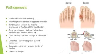 Pathogenesis
 1st metatarsal inclines medially
 Proximal phalynx deflects in opposite direction
 Joint knuckles towards the midline –
prominence of forefoot at the tibial border
 Great toe pronates – Nail and hallux slants
medially, pulp towards second toe
 Great toe may ride over 2nd digit or slip under
it
 Lesser toe – crowded together, clawed,
hammered
 Bunionette:- deformity at outer border of
forefoot
 Forefoot is splayed
 
