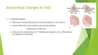 Anatomical changes in foot
 1. Articular bones
 Mild cases: Outward deviation of proximal phalynx is the sole feature
 Severe deformity: Axial rotation of proximal phalynx
: Subluxation of MP joint.
 Crista on the undersurface of 1st Metatarsal smoothens out, effaced due
to migration of sesamoid.
 