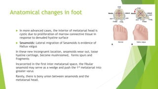 Anatomical changes in foot
 In more advanced cases, the interior of metatarsal head is
cystic due to proliferation of marrow connective tissue in
response to denuded hyaline surface
 Sesamoids: Lateral migration of Sesamoids is evidence of
Hallux valgus
In these new incongruent location, sesamoids wear out, loose
hyaline cartilage, become mushroomed, forms spurs and
fragments
Incarcerted in the first inter metatarsal space, the fibular
sesamoid may serve as a wedge and push the 1st metatarsal into
greater varus
Rarely, there is bony union between sesamoids and the
metatarsal head.
 